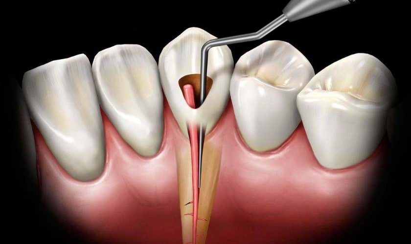 Endodontic Dentistry